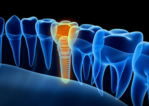 Implant dentaire paris 2 : lexique