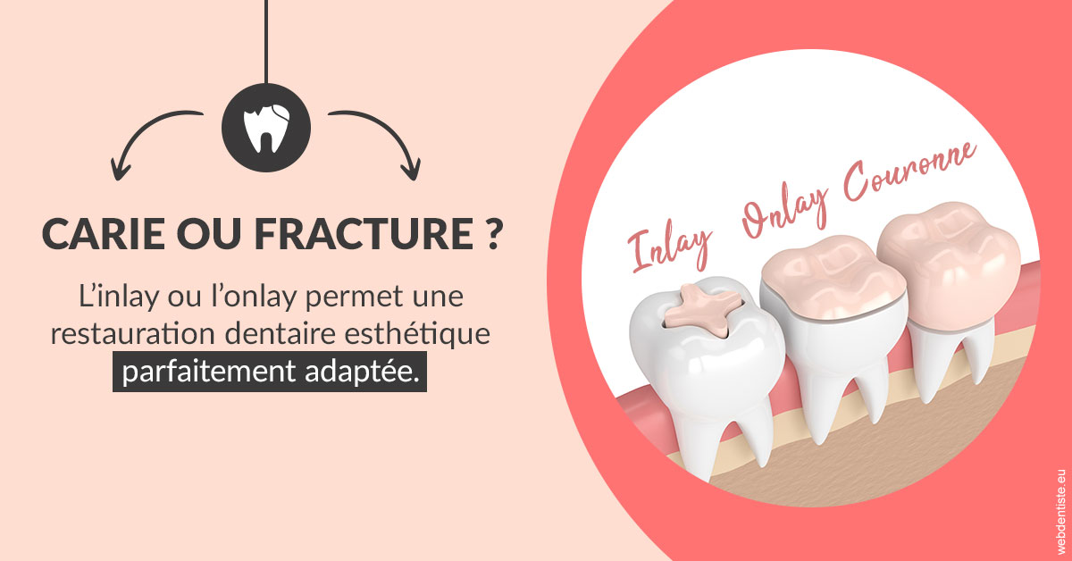https://dr-touitou-yvan.chirurgiens-dentistes.fr/T2 2023 - Carie ou fracture 2