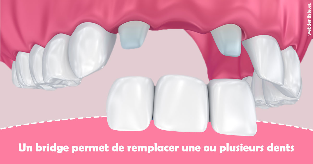 https://dr-touitou-yvan.chirurgiens-dentistes.fr/Bridge remplacer dents 2