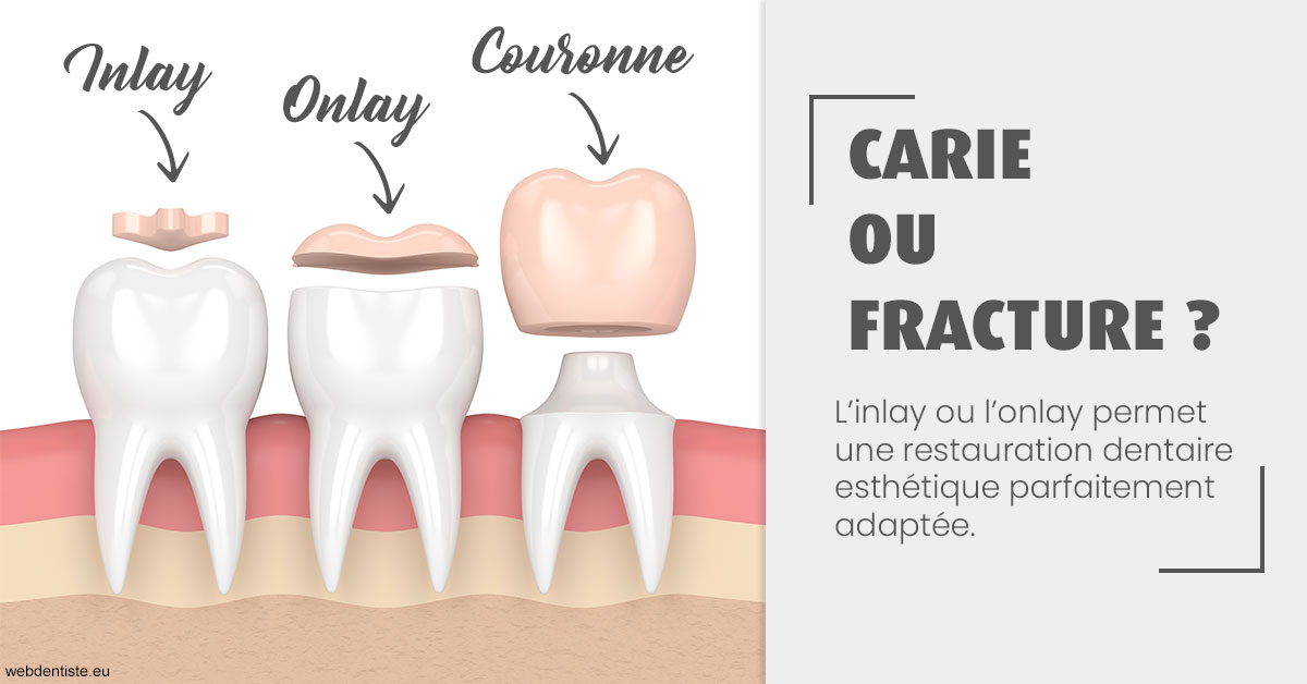 https://dr-touitou-yvan.chirurgiens-dentistes.fr/T2 2023 - Carie ou fracture 1
