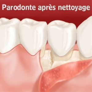 La parodontologie : soins des gencives paris 2