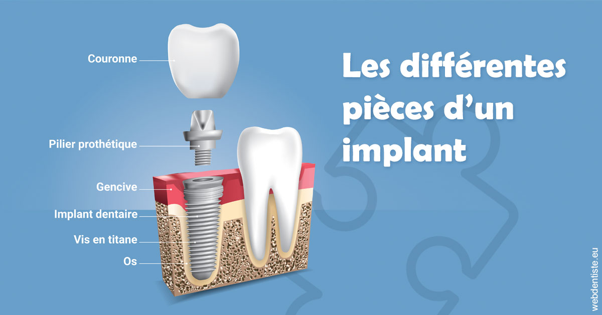 https://dr-touitou-yvan.chirurgiens-dentistes.fr/Les différentes pièces d’un implant 1